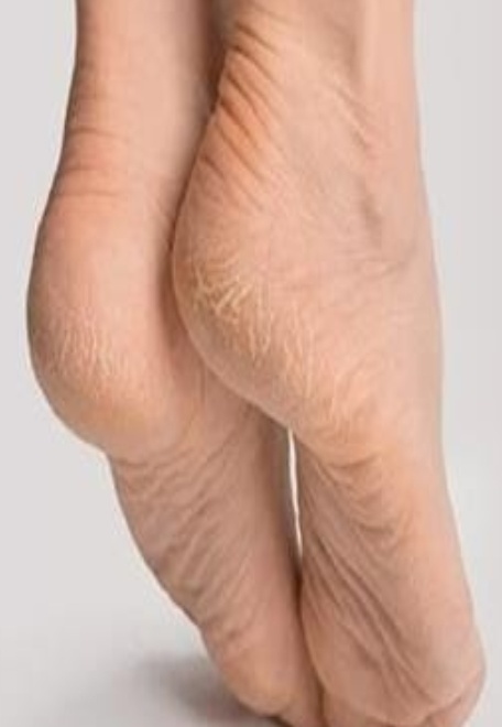 ਅੱਡੀਆਂ ਸਰਦੀਆਂ ਵਿੱਚ ਜ਼ਿਆਦਾ ਕਿਉਂ ਫਟਦੀਆਂ ਹਨ? ਜਾਣੋ …ਕਾਰਨ,ਅਤੇ ਘਰੇਲੂ ਇਲਾਜ